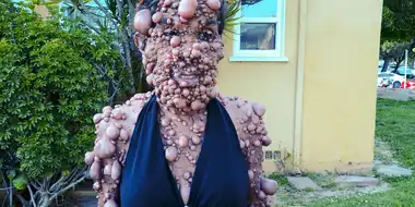 The Woman Covered in Thousands of Tumors