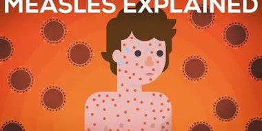 Measles Explained — Vaccinate or Not?